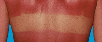 Sun sensitivity and accutane